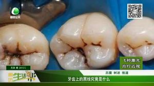 牙齒上的黑線到底是什么