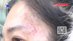 美容差點(diǎn)變毀容 愛美人士需謹(jǐn)慎