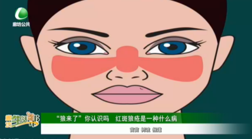 “狼來(lái)了”你認(rèn)識(shí)嗎 紅斑狼瘡是一種什么病